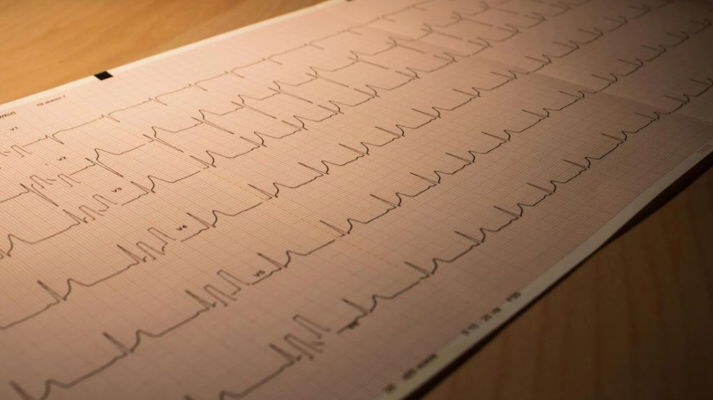Cardiologia: l'inquinamento atmosferico causa dell'aumento degli infarti