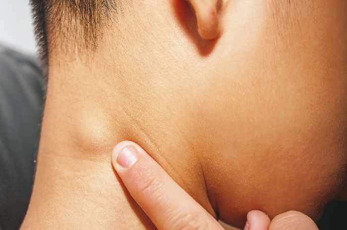 Sindrome di Castleman