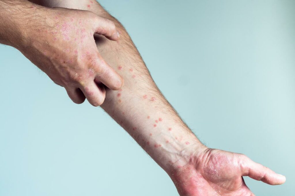 Giornata Mondiale del Lupus, il ruolo della Lupus Unit