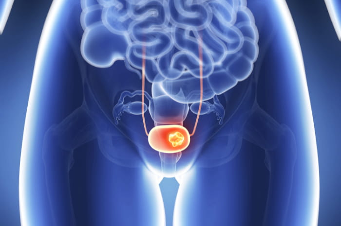 FDA da il via libera al farmaco di UroGen per il cancro alla vescica